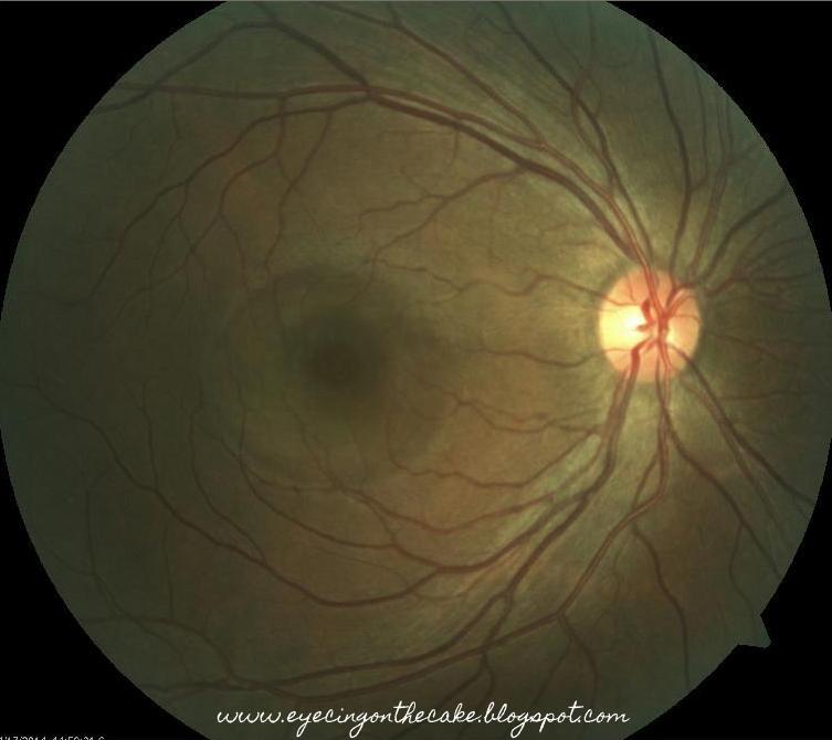 eyecing on the cake central serous chorioretinopathy