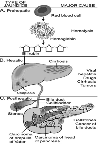 Dubin Johnson Liver
