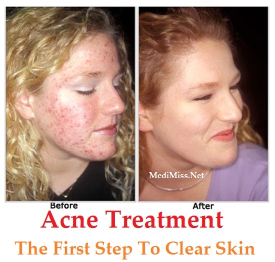 Acne yeast, acne treatment light box, clear skin acne treatment, best