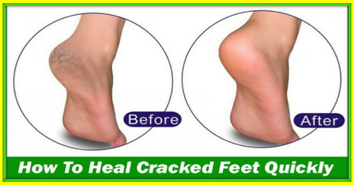 1eccellente This Is How To Heal Cracked Feet Quickly With This 5