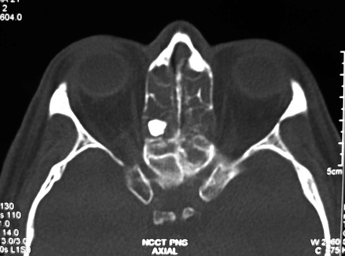 Radiodiagnosis Imaging is AmazingInteresting cases Ivory Osteoma