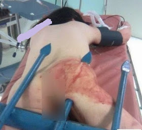 www.vietyo.com 94acabeea79830 Nữ sinh bị thanh sắt đâm xuyên phần mông vì trốn cha mẹ đi chơi đêm
