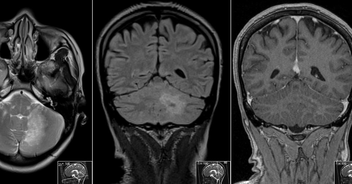 Radiology MRI PML in HIV Cerebellum