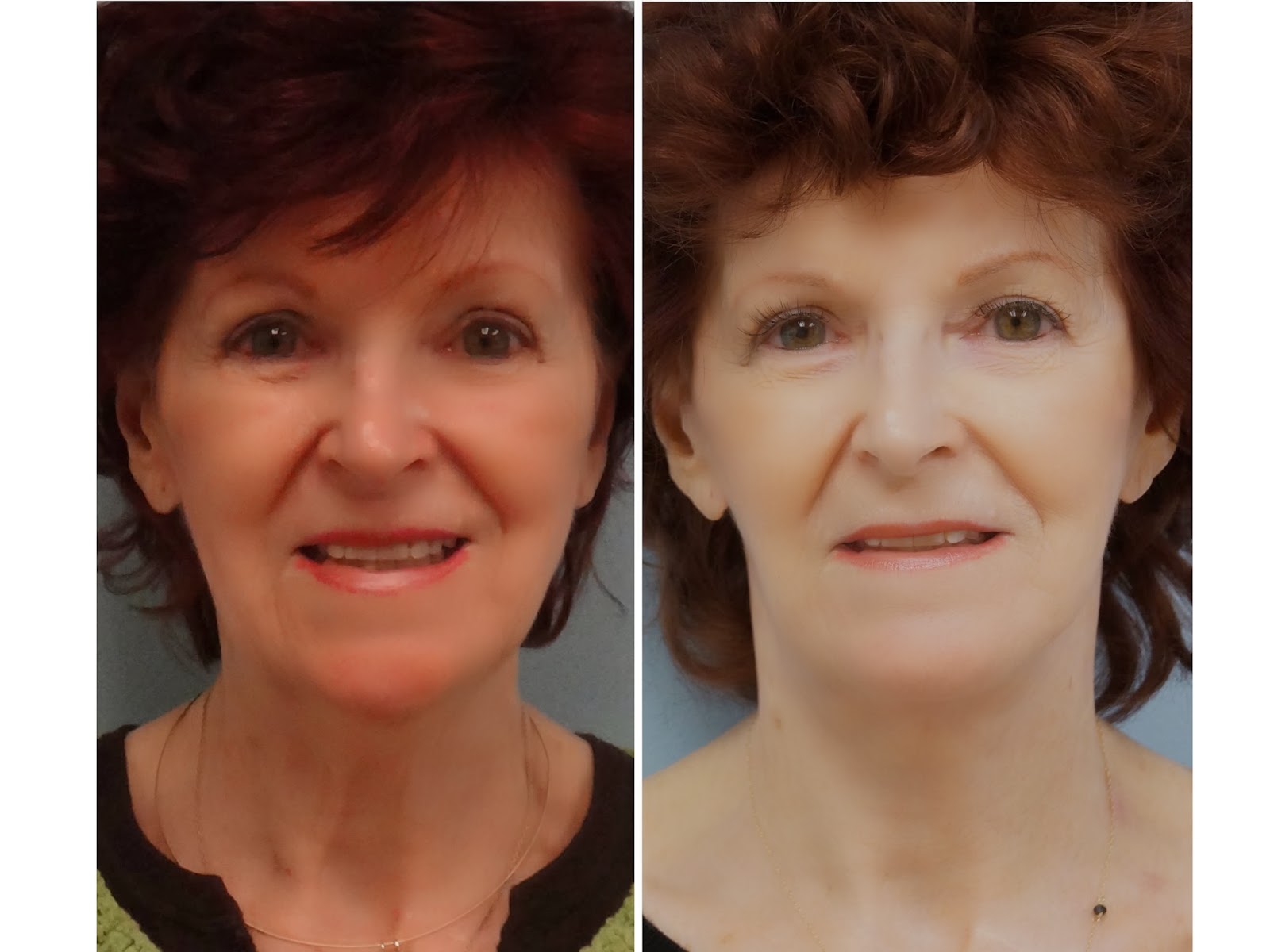 Facial Plastic Surgery Facelift, Necklift, Platysmaplasty, ERBYAG