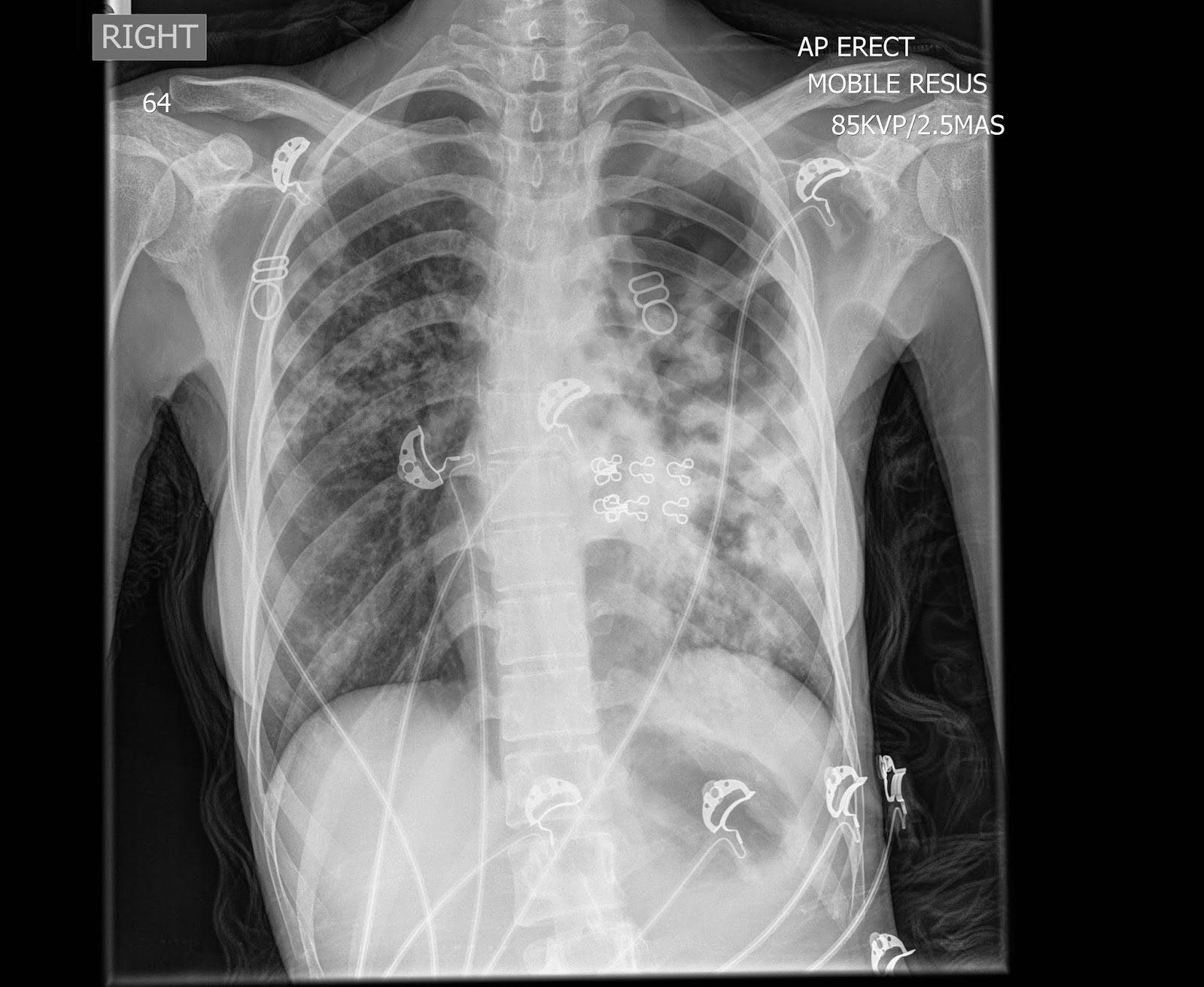 the xray doctor xrayoftheweek 15 shortness of breath and cough why?