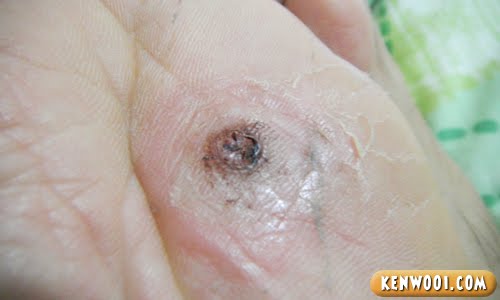Corn Foot Removal