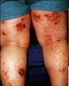 Salep kortikosteroid untuk dermatitis