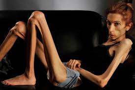 12.Anorexia
