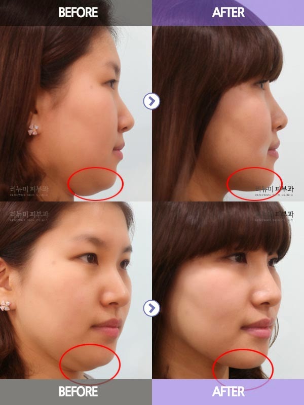 Renewme Skin Clinic Laser Lipolysis for Your Double Chin ACCULIFT in