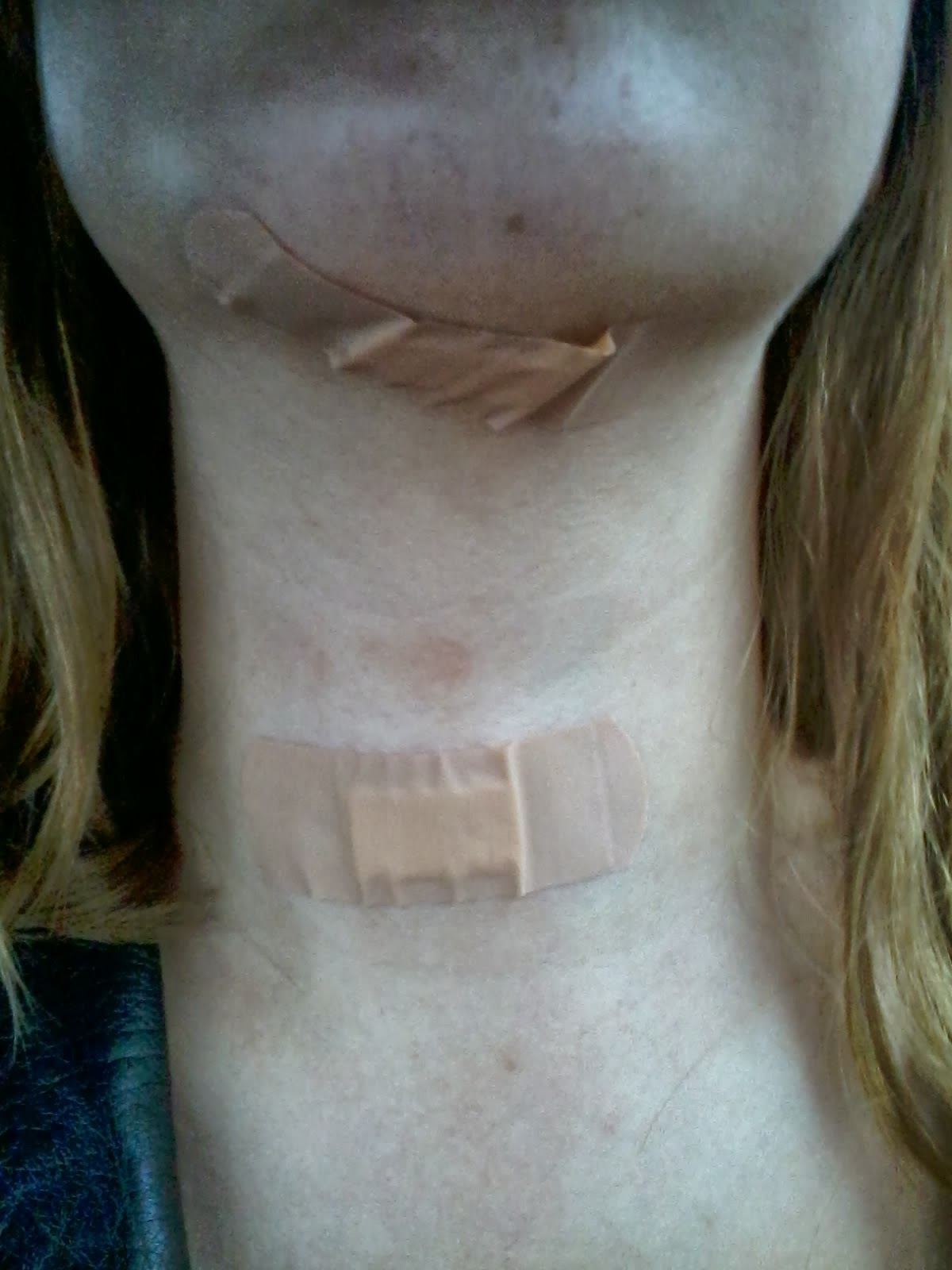 Surprise thyroid cancer Went For Deviated Septum, Came Out With Cancer