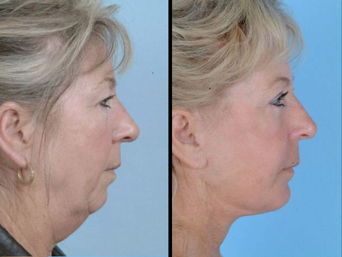 A Facial Exercise Toning Program That Results In Natural Facelifts Do