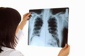 mesothelioma symptoms