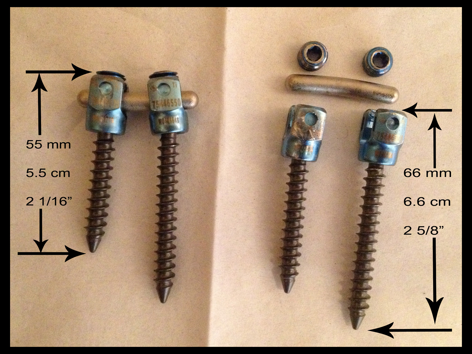 Anterior Lumbar Spinal Fusion Viewing Gallery
