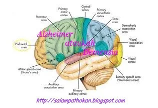 Anatomi otak manusia : Perbedaan Alzheimer Dengan Demensia