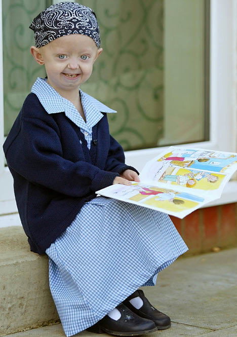 Hayley Okines: um verdadeiro milagre de Deus As+quoted+from+the+page+of+the+Daily+Mail,+progeria+sufferer+Hayley+is+the+first+child+who+underwent+medical+therapy+FTIs+(farnesyltransferase+inhibitors).