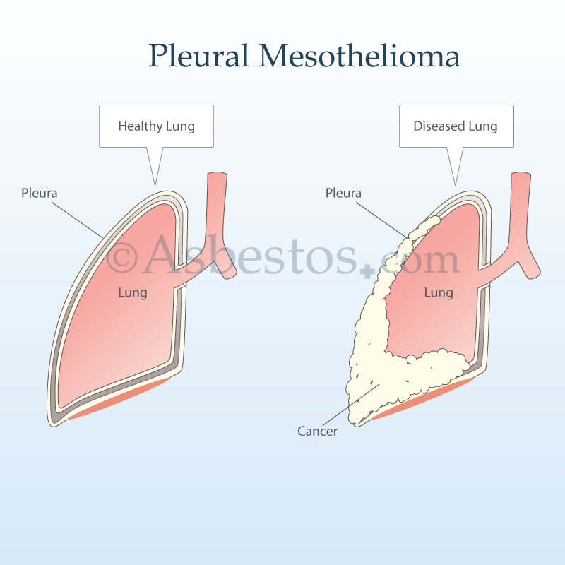 Mesothelioma Pictures