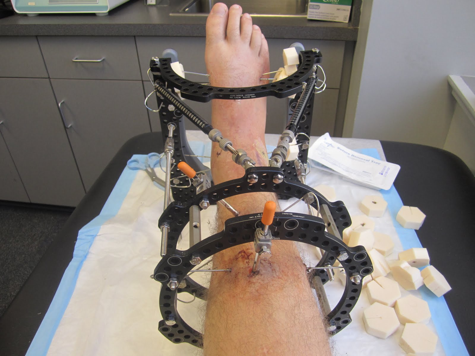 ankle distraction arthroplasty