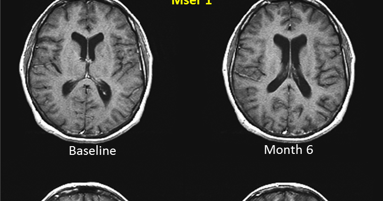 What are some effective treatments for brain atrophy?