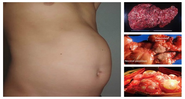 symptome cancer pancreas chez femme