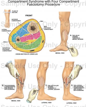 Compartment Syndrome