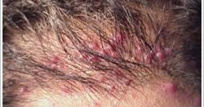 Pengobatan Tradisional Folikulitis Terbaru Dan Aman | Pengobatan Tradisional Paru Paru Basah