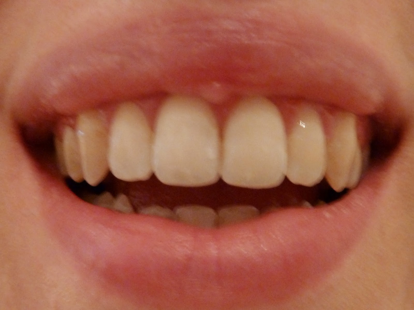 Week 78 Brace Debonding Appointment