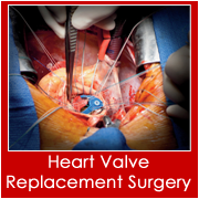 Heart Valve Replacement in India