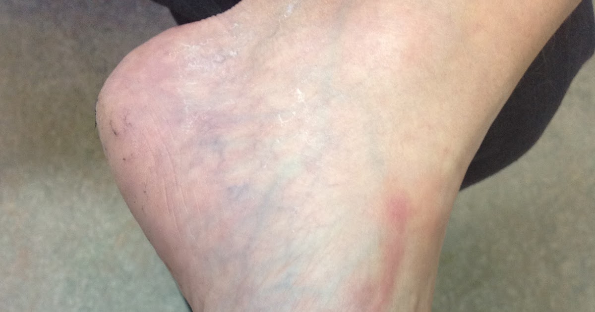 Infectious diseases and tropical medicine Beach holiday foot rash