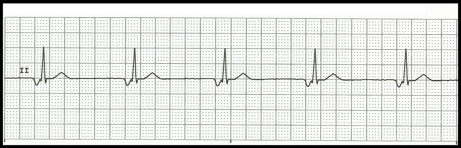 Float Nurse Characteristics of Junctional Rhythms