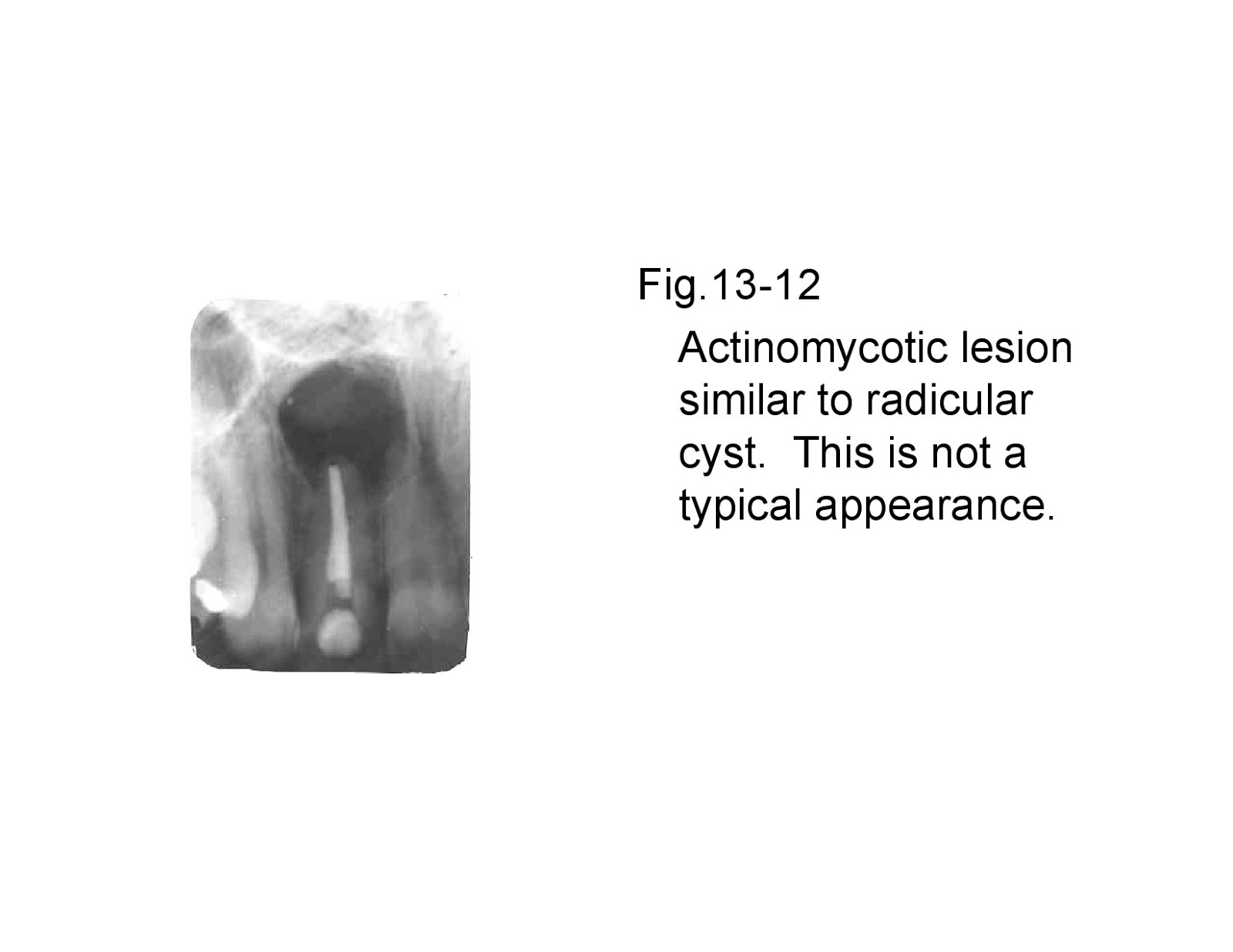 Osteomyelitiswith Radiological features Dentistry and Medicine