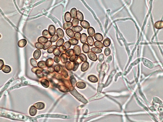 Возбудитель отрубевидного лишая грибок Microsporon furfur