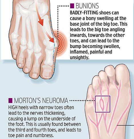 feet bunion Related Shoe GIRLS: Problems  for BUNION Illustrated shoes Foot