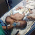 Photos: Conjoined Male Twins Born at UNTH Nsuka