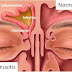 Cara Mengobati Penyakit Sinusitis Telah Terbukti Ampuh