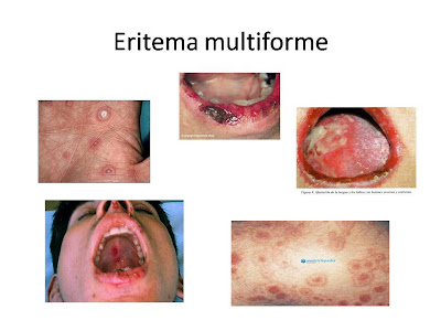 Eritema multiforme