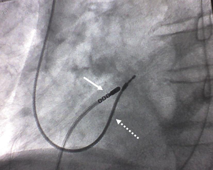 HEALTH FROM TRUSTED SOURCES Atrial fibrillation