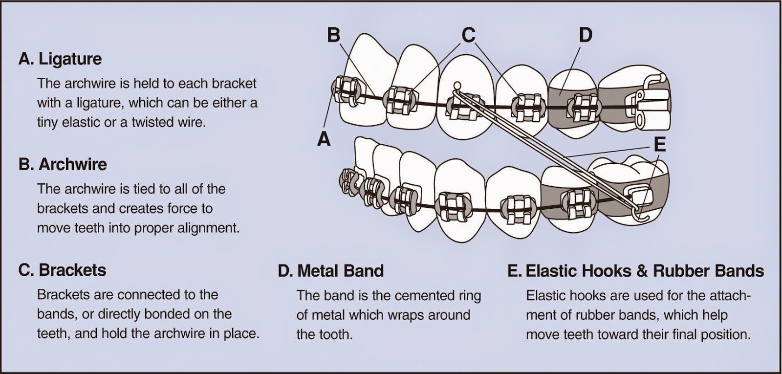 leonidrain Resiko Umum yang Dialami oleh Pengguna Alat Orthodontik Cekat