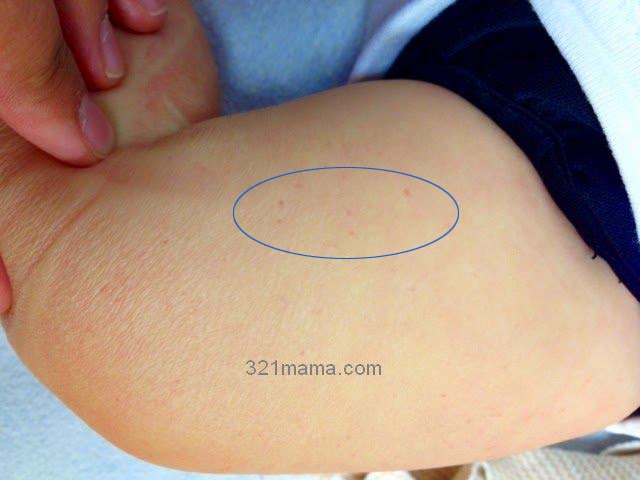 pinpoint red dots on skin that bleed pinpoint red dots on skin that bleed