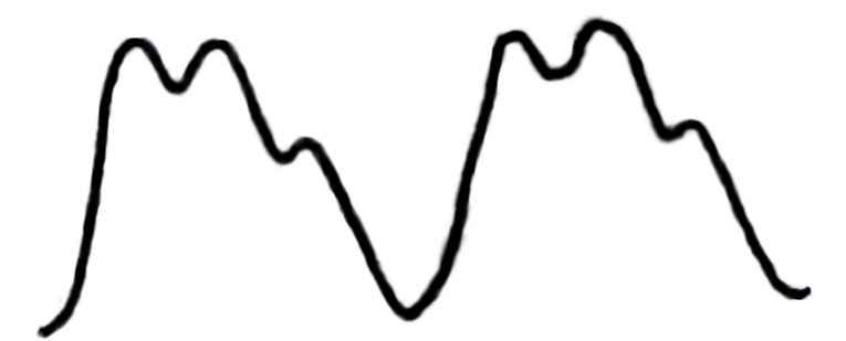 MBBS Medicine (Humanity First) Abnormal Pulses and Possible Etiologies