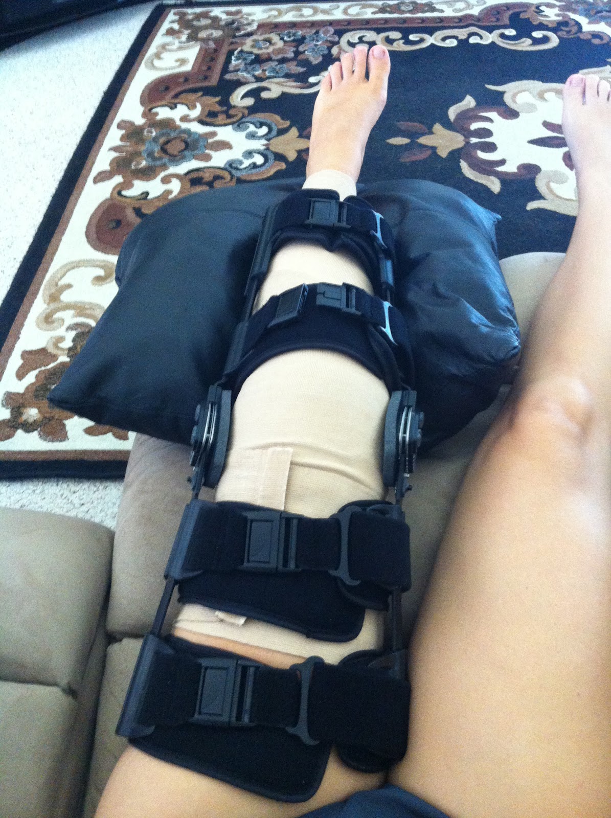 MPFL Reconstruction and Microfracture Knee Surgery