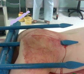 www.vietyo.com 94acabeeb86f18 Nữ sinh bị thanh sắt đâm xuyên phần mông vì trốn cha mẹ đi chơi đêm