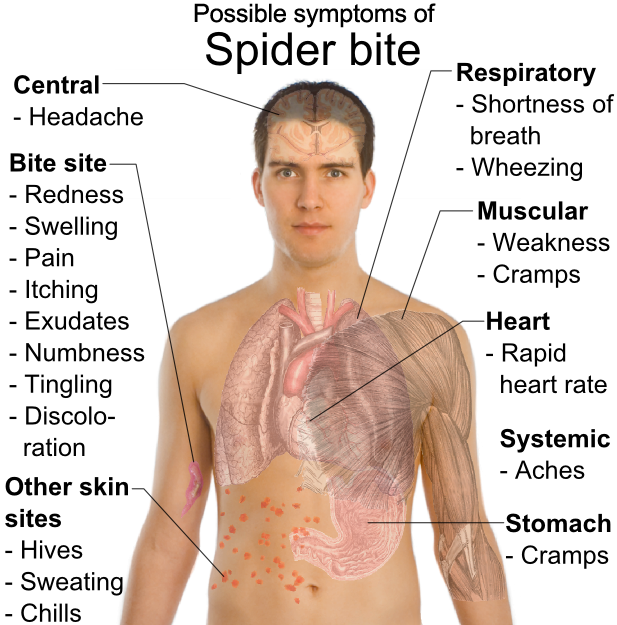 spider bite symptoms treatment. spider bite symptoms