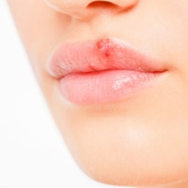 Water Blister On Lip Treatment