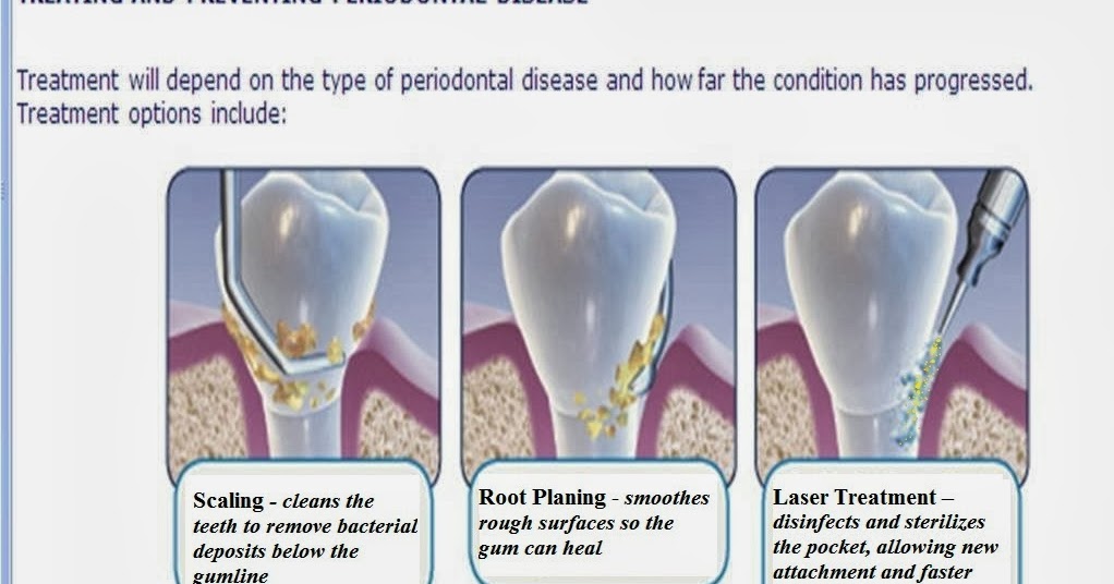 Crow Family Dental Laser Periodontal Therapy