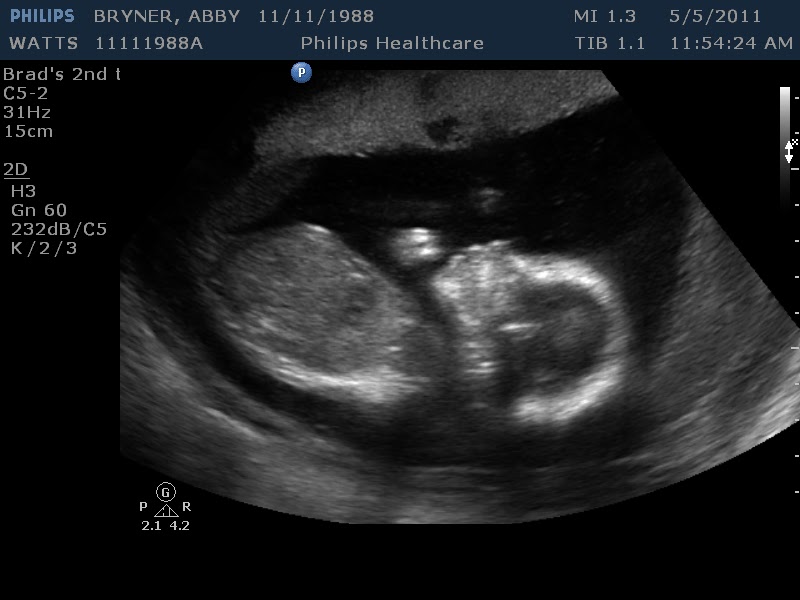 3d ultrasound 20 weeks pregnant. 3d ultrasound 20 weeks boy. 20 Week Ultrasound
