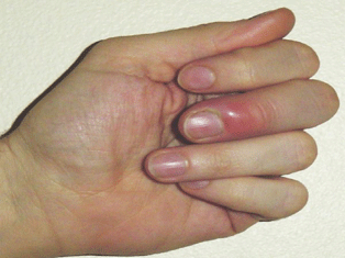 Acrylic Nails Nail Fungus Market Today Show Great Promise As Relatively Inexpensive And Effective Treatments For Both Natural Fungal Nail Infections Artificial Fungus