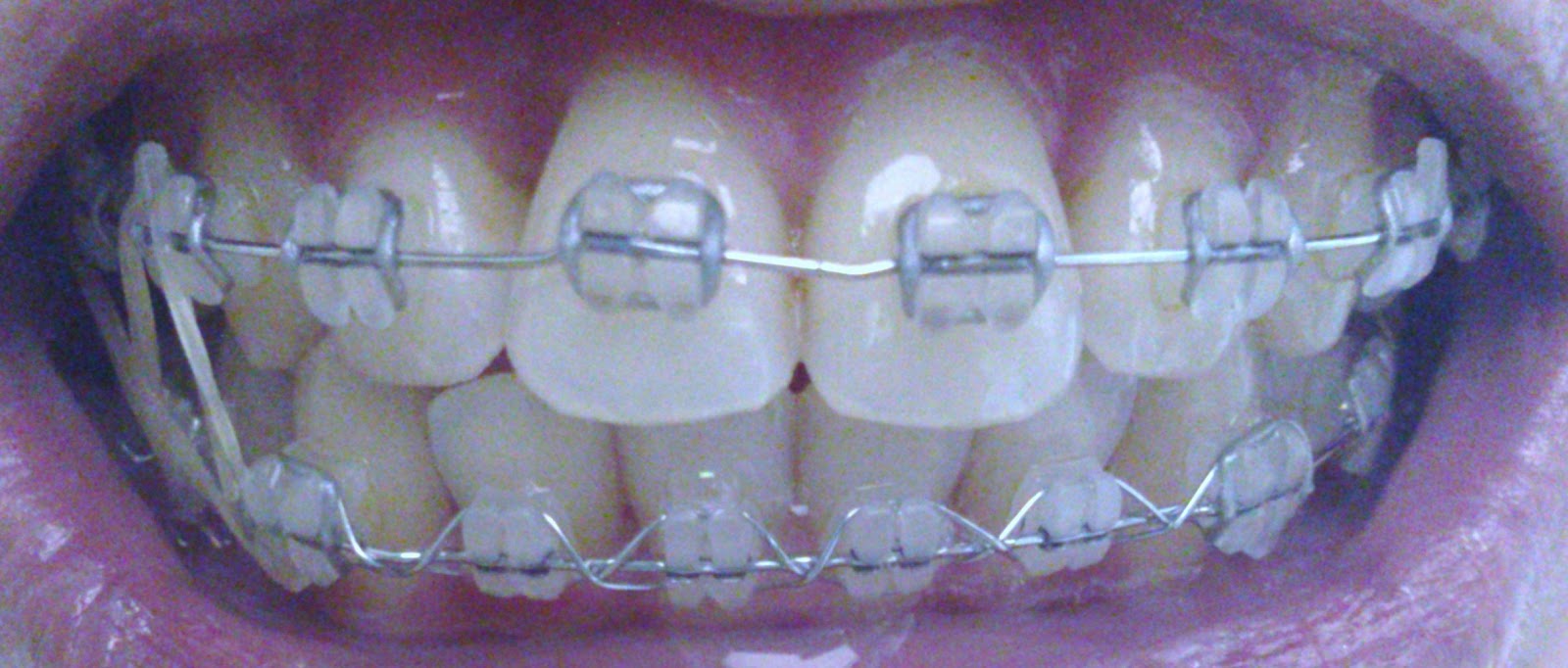 Braces at 25