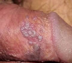 Penyakit Herpes Di Kelamin