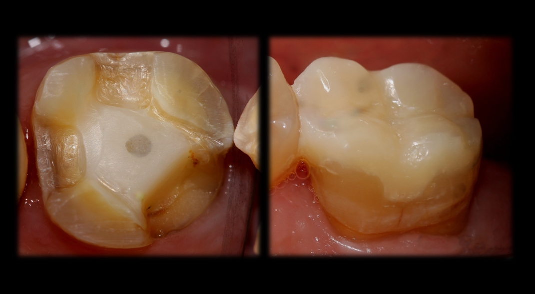 Máster en Odontología Restauradora y Endodoncia: Retratamiento de