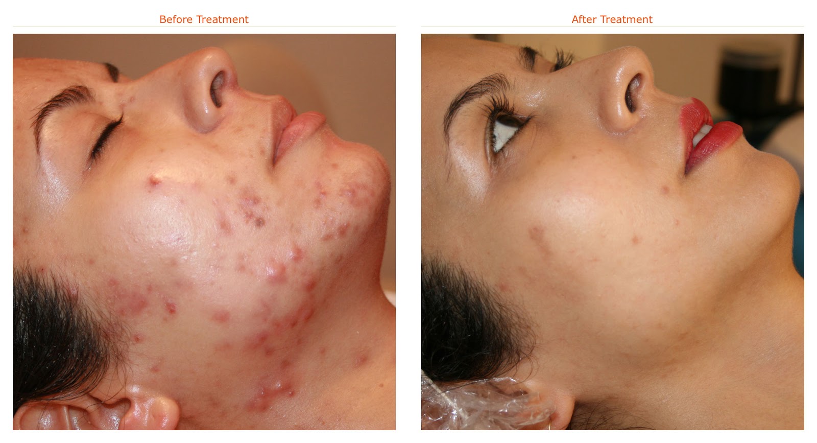 best ways to get rid of acne